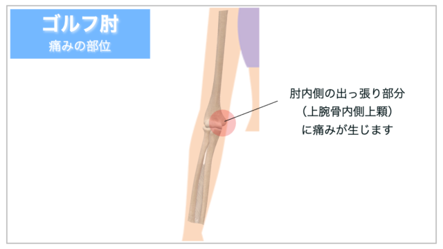 ゴルフ肘　上腕骨内側上顆炎